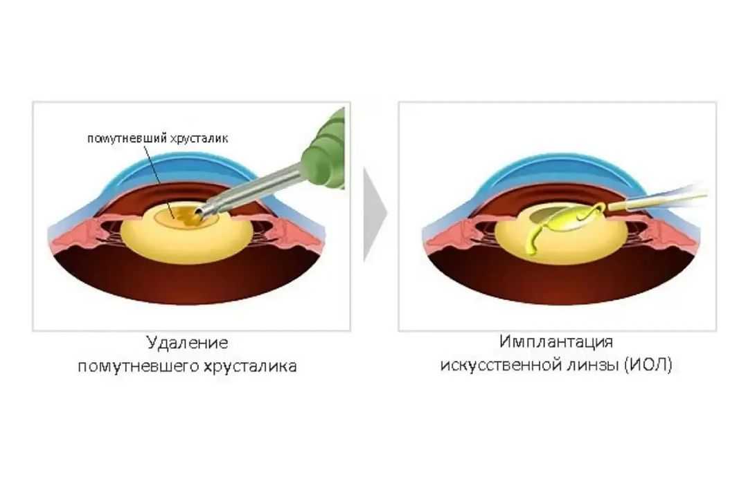 Операция катаракта замена хрусталика отзывы. Катаракта факоэмульсификация. Искусственный хрусталик глаза. Замена хрусталика схема. Операция по замене хрусталика глаза.
