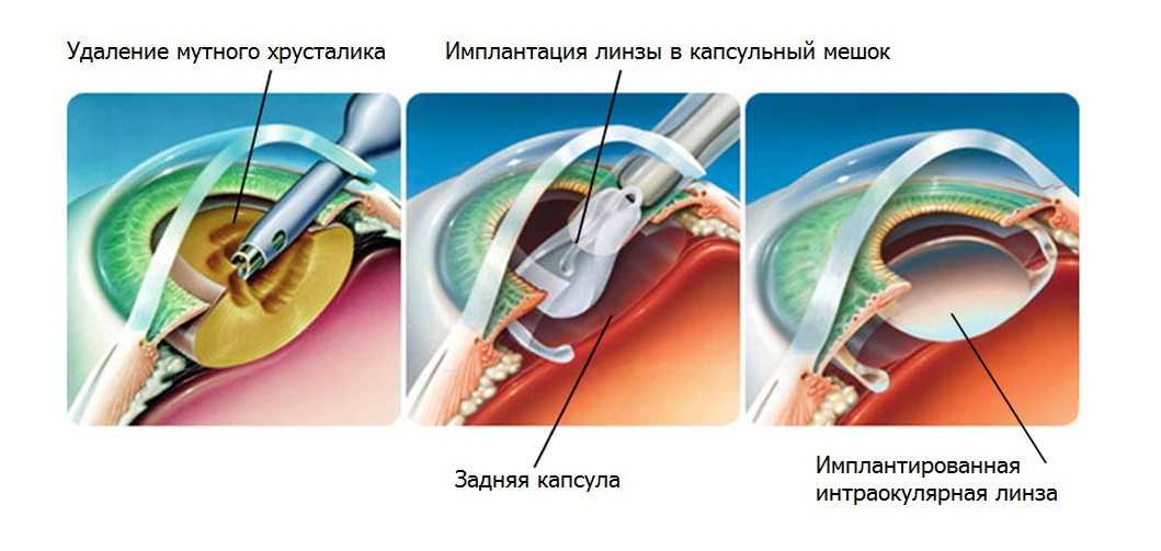 Факоэмульсификация катаракты с имплантацией. Факоэмульсификация катаракты с имплантацией интраокулярной линзы. Ультразвуковая факоэмульсификация катаракты. Что делать после операции по замене хрусталика